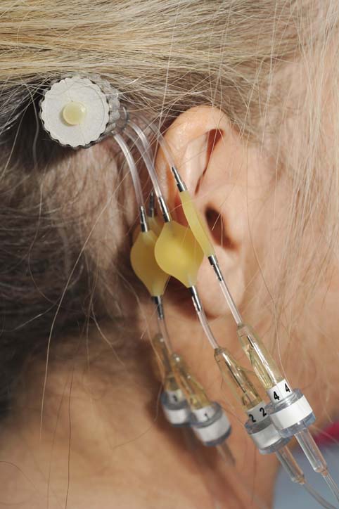 McMurtry was inspired by a bone-anchored hearing aid behind the ear