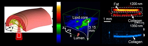 Researchers have developed a new type of imaging technology to diagnose cardiovascular disease and other disorders by measuring ultrasound signals from chemical bonds in molecules exposed to a pulsing laser.