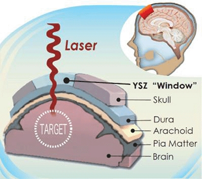 This is an illustrated cross section of the head that shows how the transparent skull implant works