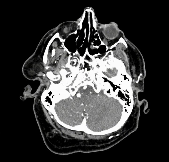 brain aneurysms