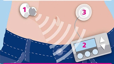 Artificial pancreas: 1. Glucose levels monitored continuously 2. Required insulin dose calculated 3. Insulin does delivered automatically  Diabetes UK