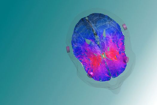 A model image of the targeted deep brain zone, the striatum, a key player in reward and reinforcement mechanisms