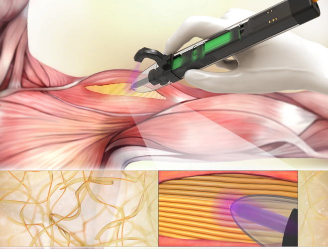 handheld 3d bioprinter