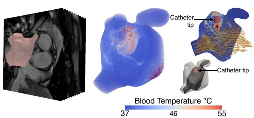 Personalised heart simulations