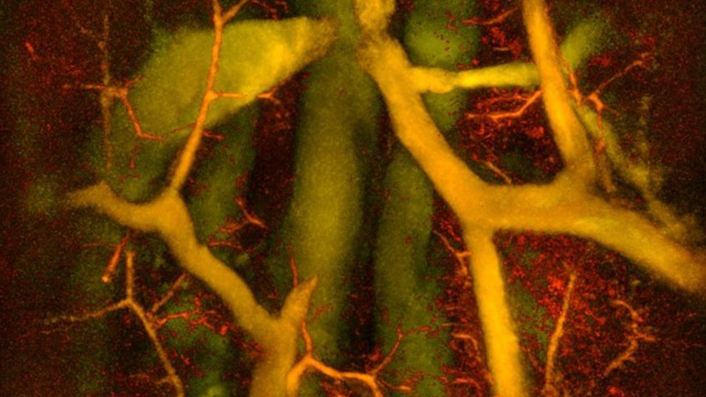 PAT scanning can detect subtle structural changes in blood vessels