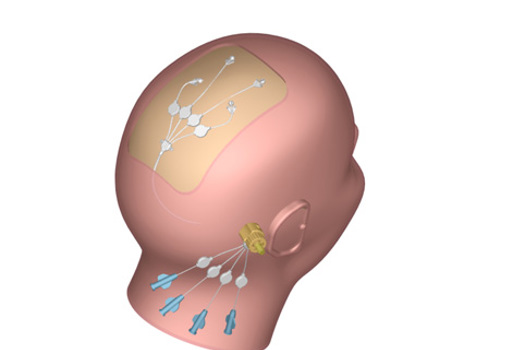  The Renishaw technique puts the drug on the other side of the blood-brain barrier