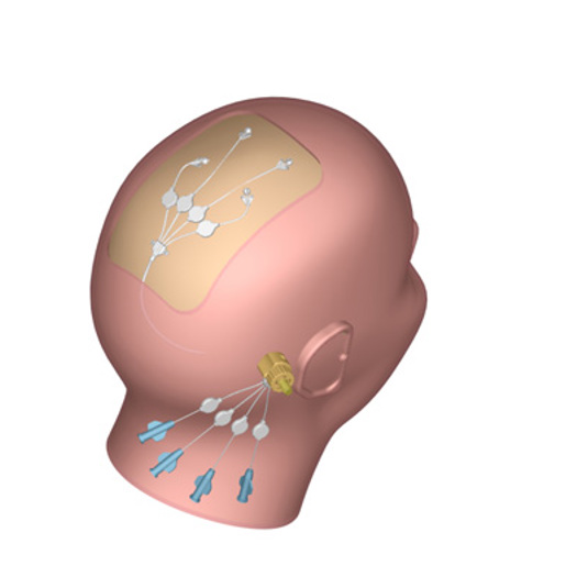 The Renishaw technique puts the drug on the other side of the blood-brain barrier