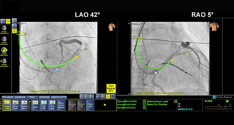 Two angulations showing MediGuide-enabled non-fluoroscopic tracking of guiding catheters and wires