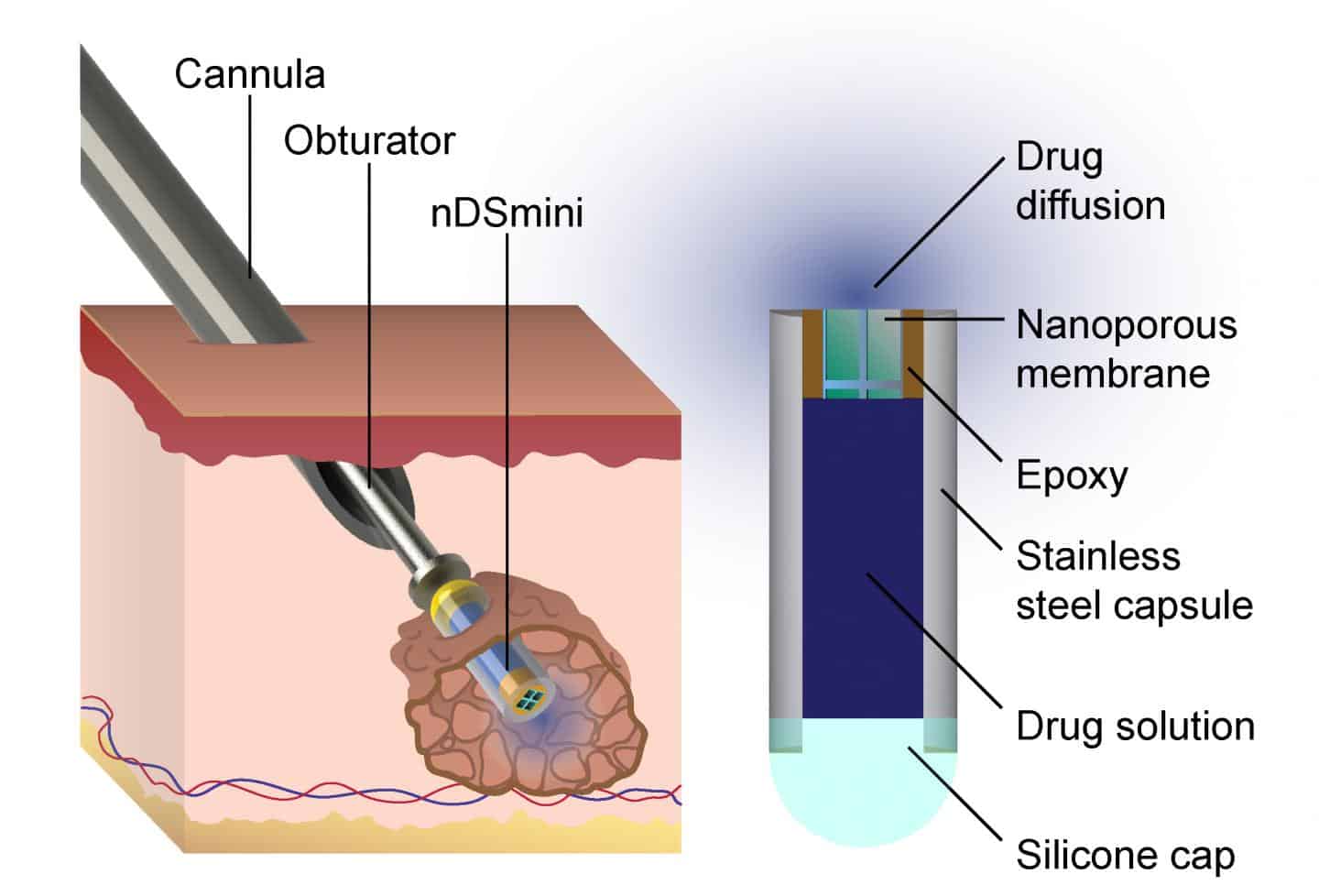 The nDSmini nanofluidic device, shown in section and being implanted.