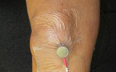 UK researchers have developed a device that identifies osteoarthritis through sounds emitted by the body