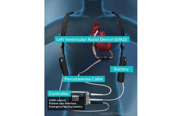 comsol ventricle assist