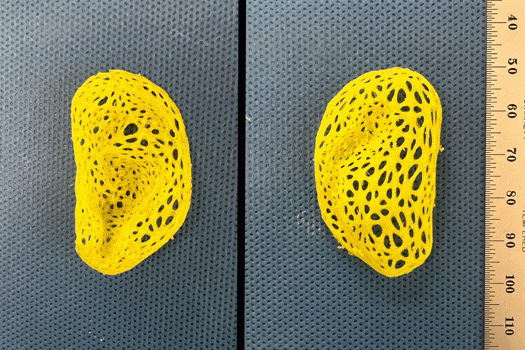 Pictured is the left-ear plastic scaffold that was created on a 3D printer based on data from a person’s ear, anterior view (left) and posterior view (right)