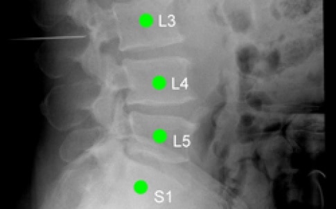 LevelCheck software clearly labels each vertebra in this X-ray image taken just before a patient’s spinal surgery. Note the pin to the left of L3. L and S stand for the lumbar and sacral regions of the spine, respectively