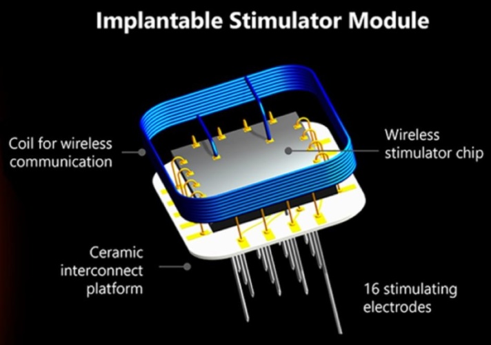 First human implantation of the WFMA for intracortical visual