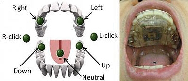 The circuitry for the new intraoral Tongue Drive System developed at Georgia Tech is embedded in this dental retainer worn in the mouth (right). The system interprets commands from seven different tongue movements to operate a computer (left) or maneuver