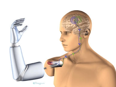When amputee patients have received their new prosthesis, it will be controlled with their own brain signals. The signals are transferred via the nerves through the arm stump and captured by electrodes. These will then transmit the signals through a titan