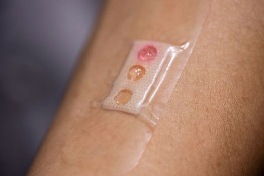 The plaster developed by NTU Singapore researchers comprises microlaser sensors embedded in liquid crystal droplets. The sensors are customised to pick up three different types of biomarkers (lactate, glucose, urea). A different coloured liquid crystal dot on the plaster distinguishes each biomarker