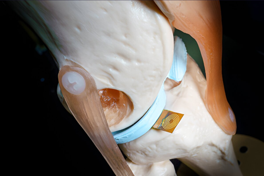 A biocompatible force sticker placed within a model knee joint