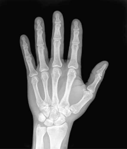 X-ray of a human hand 