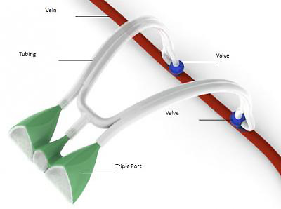 An illustration of a closeup view of the Hemova Port, connected below the skin in the patient’s leg to a femoral vein