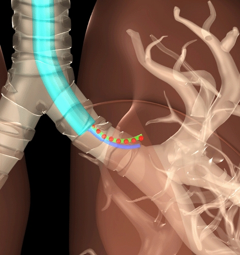 This graphic illustrates a surgical tool in a human lung. The blue curve corresponds to what the device is expected to do. The green curve represents what would happen in a real procedure were some perturbations introduced. The red-dots represent the esti