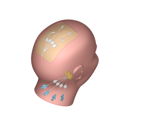 The Renishaw technique puts the drug on the other side of the blood-brain barrier