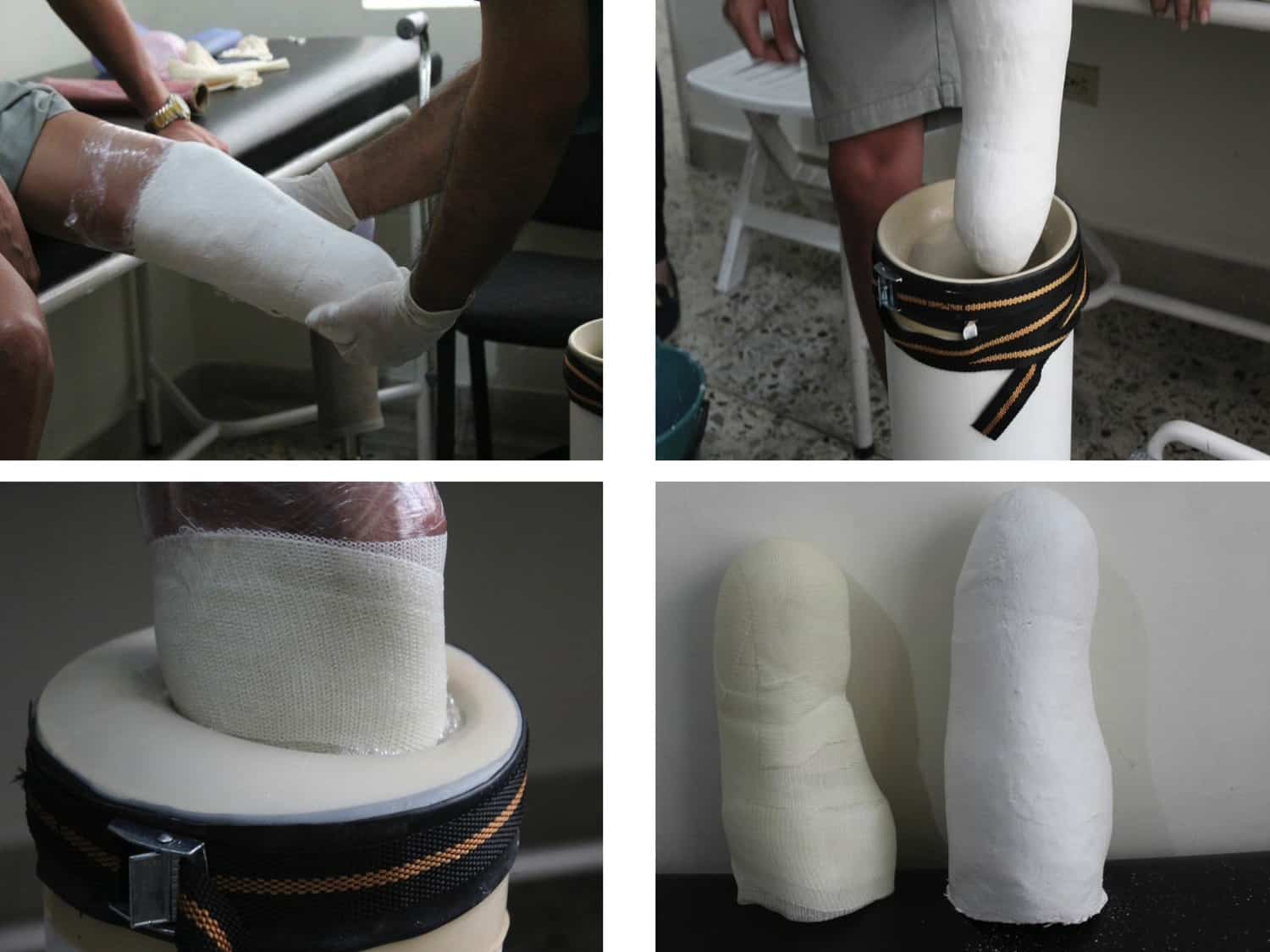 Majicast captures the unique shape of lower residual limbs with the use of plaster bandages or other direct casting material