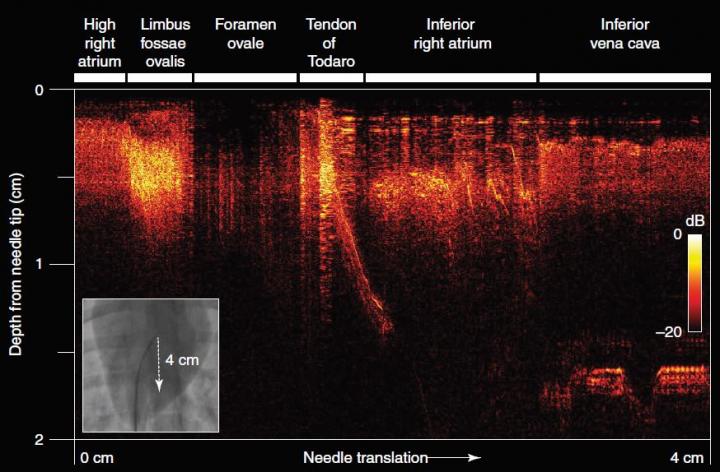 optical ultrasound