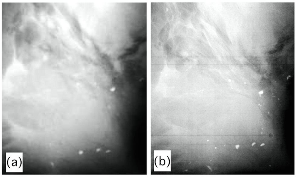 In vitro breast specimen (left) and one taken using phase contrast X-ray imaging at UCL (right).