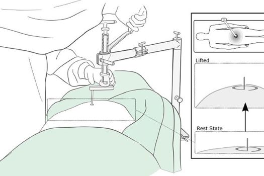 Graphic shows how the retractor lifts the abdominal wall