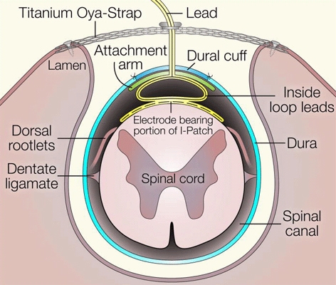 Cross-sectional schematic diagram of the spinal canal with the HSCMS device in place on the pial surface. The silicone membrane containing the electrodes conforms to the dorsal arc of the spinal cord and is held in place by the restoring force exerted by